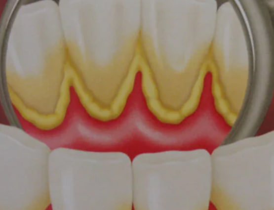 Como prevenir o tártaro – aquelas manchas ao redor dos dentes