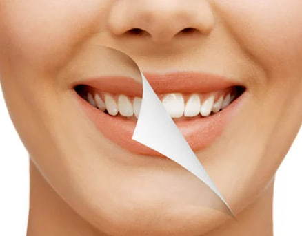 Mitos e Verdades sobre Clareamento Dental