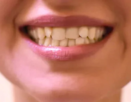 Meus dentes estão tortos. Devo usar aparelho?