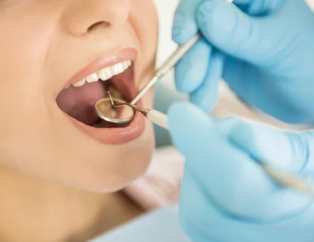 Verdades e mitos sobre os dentes do Siso